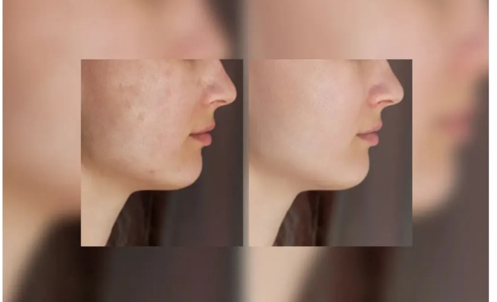 Do Glutathione Tablets Really Whiten Skin?